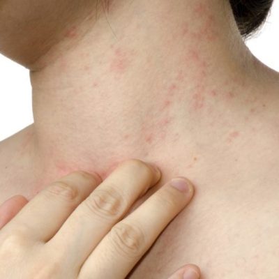 Entenda a dermatite atópica