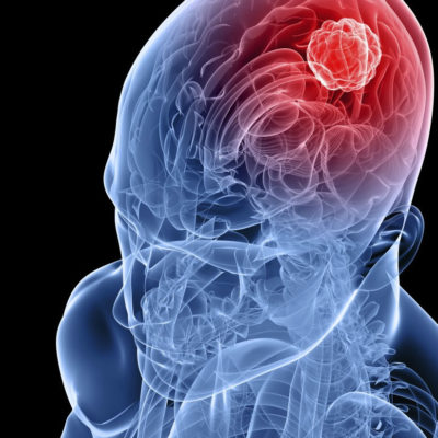 Você sabe como tratar o tumor cerebral?