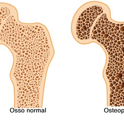Perda de massa óssea causada por osteoporose tem tratamento