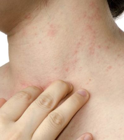 Entenda a dermatite atópica