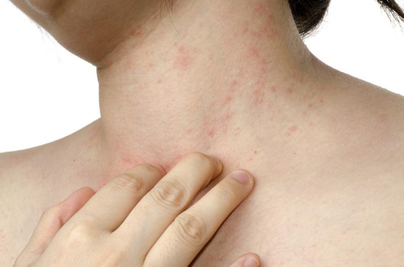 Entenda a dermatite atópica