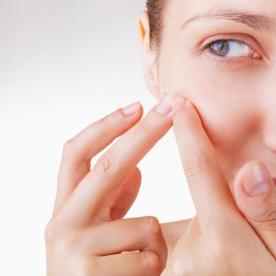 Perguntas e respostas sobre acne