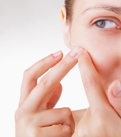 Perguntas e respostas sobre acne