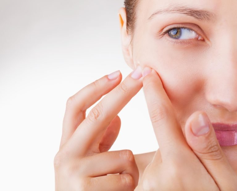Perguntas e respostas sobre acne