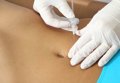 Carboxiterapia como tratamento para celulite e gordura localizada